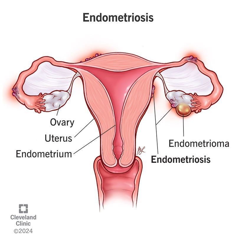 What Is Endometriosis?