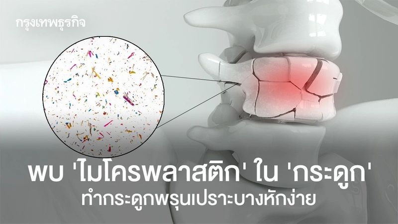 พบ ‘ไมโครพลาสติก’ ใน ‘กระดูก’ ทำกระดูกพรุนเปราะบางหักง่าย