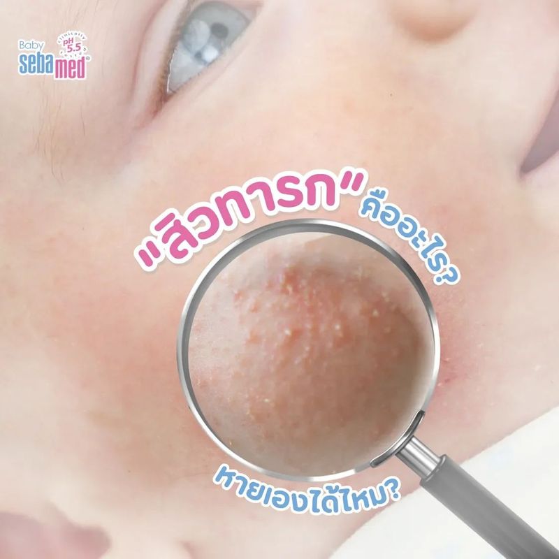 สิวทารกคืออะไร? หายเองได้ไหม?