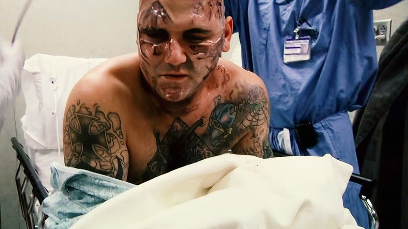 25 Surgeries to Remove His Neo-Nazi Tattoos | Erasing Hate