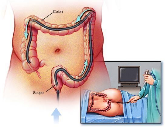 การส่องกล้องตรวจลำไส้ใหญ่ (Colonoscopy)