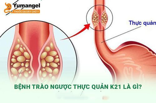 Bệnh trào ngược dạ dày thực quản: 7 nguyên nhân, 5 biến chứng và phác đồ điều trị chuẩn