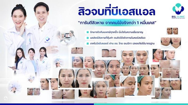 รักษาสิว รอยสิว หลุมสิว ให้สิวลดลง ผิวดูใสขึ้น โดยแพทย์ประจำ BSL