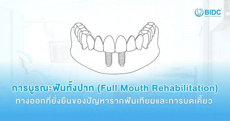 บูรณะฟันทั้งปาก ทางออกที่ยั่งยืนของปัญหารากฟันเทียมและการบดเคี้ยว | ศูนย์ทันตกรรม บางกอกเดนทัลเซ็นเตอร์ รัชดาภิเษก