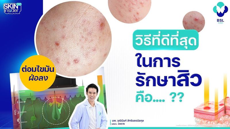 วิธีที่ดีที่สุดในการรักษาสิว คือ เลเซอร์ 1726 จริงหรือไม่? | Skin Insider EP.03 #skininsider