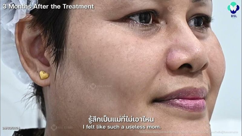 รีวิวรักษาฝ้า กระ EP.14 | เรื่องจริงของคนเป็นฝ้า จากไม่มั่นใจ เริ่มกลับมามองกระจกได้อีกครั้ง