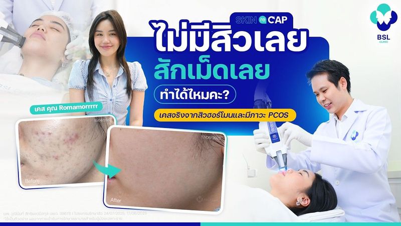 ไม่มีสิวเลยสักเม็ดเลยทำได้ไหม และ หมอจะทำได้อย่างไร? | Skin Recap EP.02