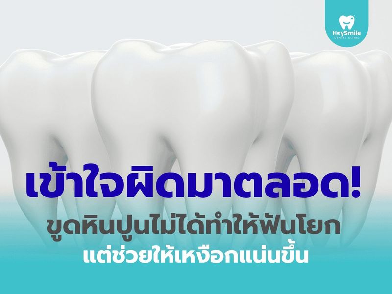 เข้าใจผิดมาตลอด! ขูดหินปูนไม่ได้ทำให้ฟันโยก แต่ช่วยให้เหงือกแน่นขึ้น​ - HeySmile Dental Clinic