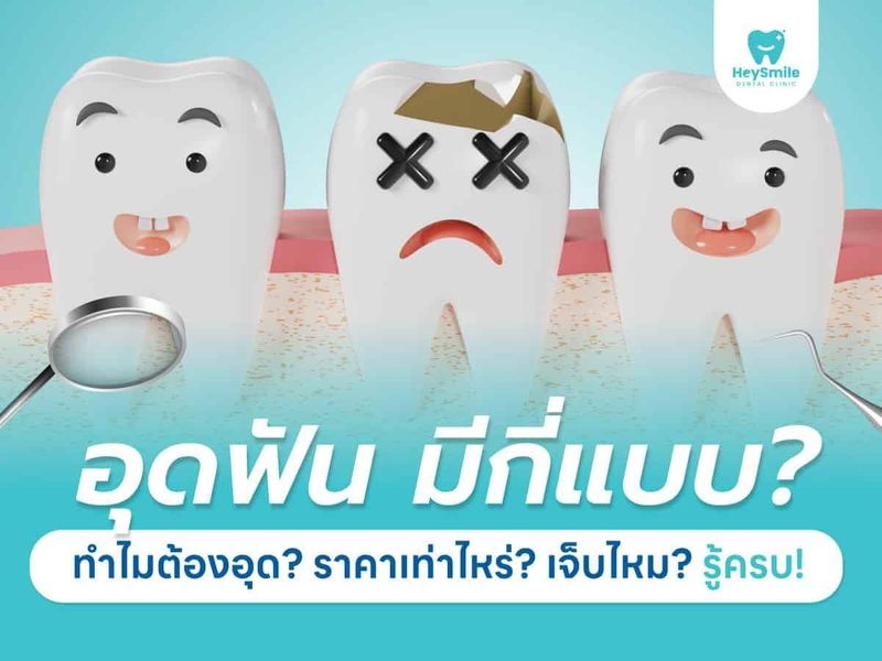 อุดฟัน มีกี่แบบ? ทำไมต้องอุด? ราคาเท่าไหร่? เจ็บไหม? รู้ครบ! - HeySmile Dental Clinic