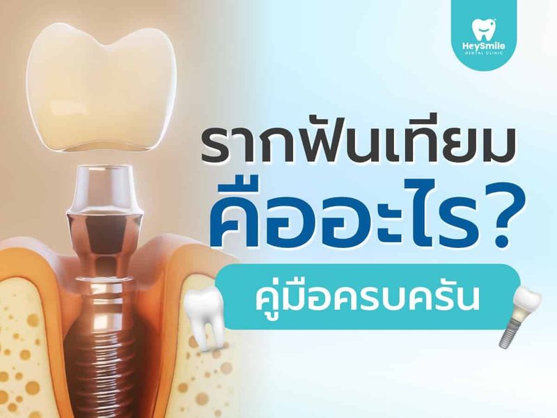 รากฟันเทียม รากฟันเทียม คืออะไร? คู่มือครบครัน | ราคา ข้อดี - HeySmile Dental Clinic