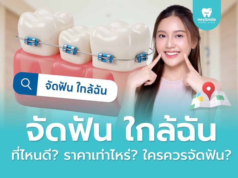 จัดฟัน ใกล้ฉัน ที่ไหนดี? จัดฟัน ราคา เท่าไหร? ใครควรจัดฟัน? - HeySmile Dental Clinic