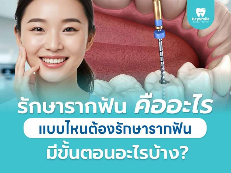 รักษารากฟัน คืออะไร แบบไหนต้องรักษารากฟัน มีขั้นตอนอะไรบ้าง? - HeySmile Dental Clinic