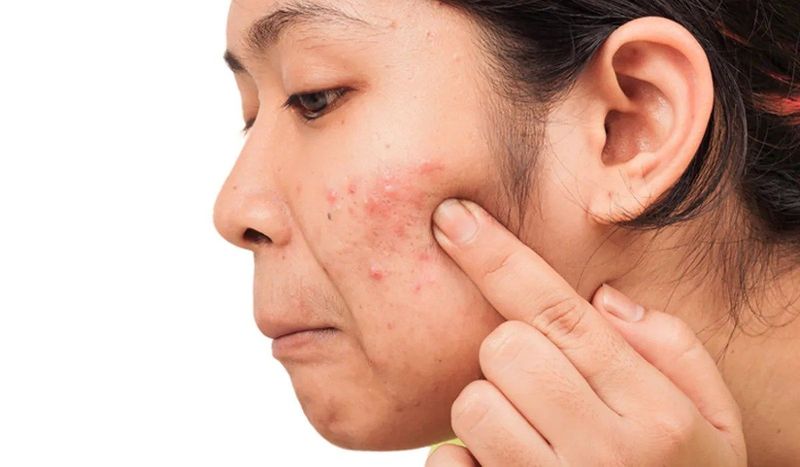 ตำแหน่งสิวบอกโรคบริเวณคาง สัญญาณเตือนเรื่องระบบฮอร์โมน
