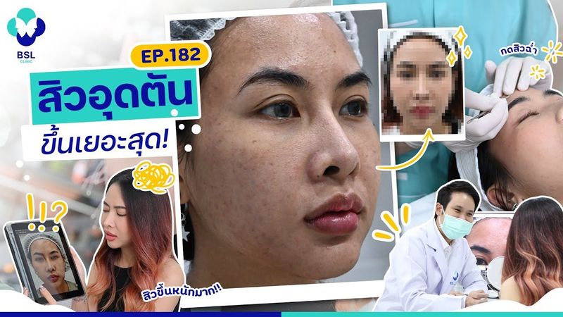 รักษาสิว | EP.182 | สิวอุดตันเยอะสุดที่เคยเป็น ตัดสินใจมาดูแลผิวที่นี่! | BSL Clinic