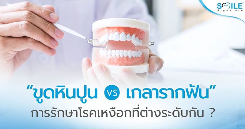 ขูดหินปูน vs เกลารากฟัน การรักษาโรคเหงือกที่ต่างระดับกัน | คลินิกทันตกรรมสไมล์ ซิกเนเจอร์