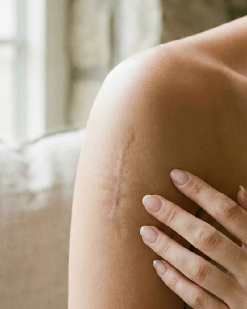 โปรแกรมรักษารอยแผลเป็น (Scar Regen)