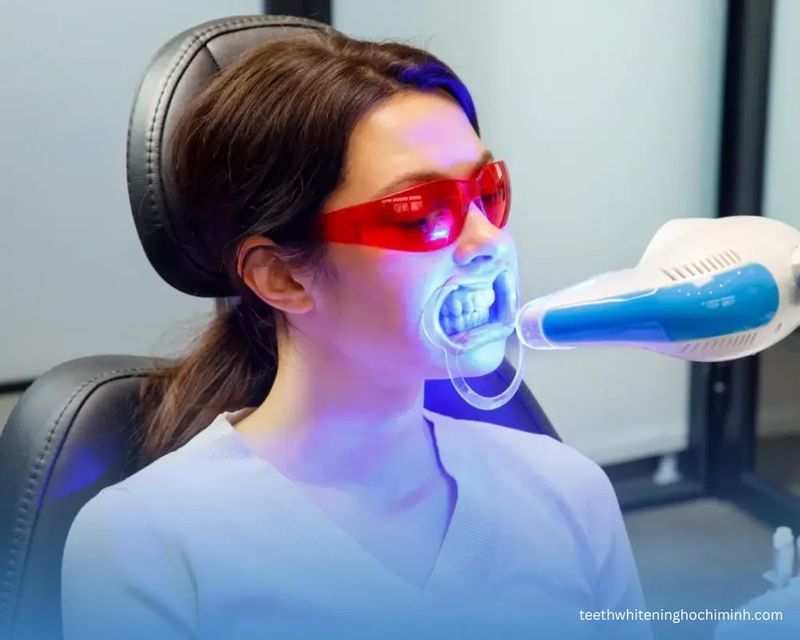 Best LED teeth whitening in Ho Chi Minh- Pros and cons 2026