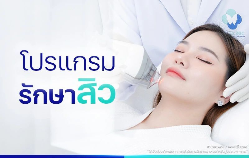 รักษาสิว รอยสิว หลุมสิว ให้สิวลดลง ผิวดูใสขึ้น โดยแพทย์ BSL