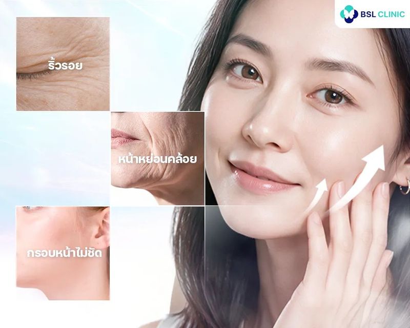 ยกกระชับหน้าเฉพาะบุคคล โปรแกรม 5D Face Lift ที่ BSL Clinic