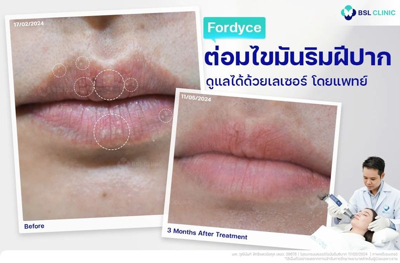 กำจัดต่อมไขมันที่ปาก fordyce spots ริมฝีปากเรียบเนียน | BSL